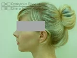 Комплексне виправлення прикусу за участю ортодонта та щелепно-лицьового хірурга – Катерина П, 23 г виправлення
