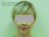 Комплексне виправлення прикусу за участю ортодонта та щелепно-лицьового хірурга – Катерина П, 23 г участю
