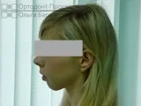 Комплексне виправлення прикусу за участю ортодонта та щелепно-лицьового хірурга – Катерина П, 23 г виправлення
