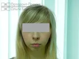 Комплексне виправлення прикусу за участю ортодонта та щелепно-лицьового хірурга – Катерина П, 23 г участю