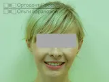 Комплексне виправлення прикусу за участю ортодонта та щелепно-лицьового хірурга – Катерина П, 23 г виправлення
