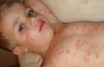 кір у дітей симптоми, лікування, діагностика, профілактика, ознаки ознаки
