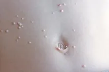 contagiosum molluscum