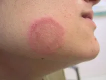 плями
