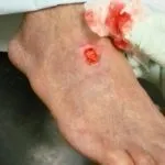 рани