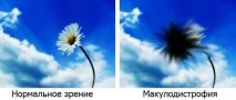 Макулодистрофія основні симптоми, профілактика та лікування симптоми