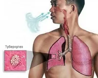 Махровий туберкульоз, що це таке туберкульоз