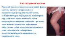 Багатоформна ексудативна еритема - фото та лікування хвороби ексудативна