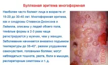 Багатоформна ексудативна еритема - фото та лікування хвороби лікування