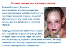 Багатоформна ексудативна еритема - фото та лікування хвороби фото