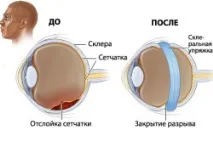 ретината симптоми