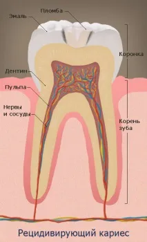 Рецидивуючий карієс рецидивуючий