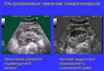 Причини панкреатиту та його наслідки його