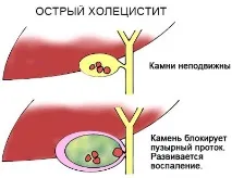 Причини та лікування болю при глибокому вдиху у правому підребер’ї болю