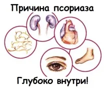 Причини виникнення псоріазу класифікація та лікування псоріазу