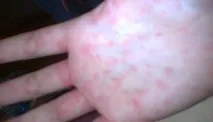 обрив мононуклеоза