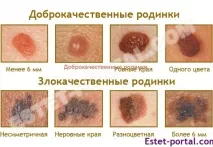 Ознаки, що характеризують небезпечні родимки небезпечні