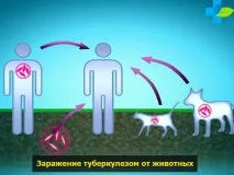 Шляхи передачі туберкульозу туберкульозу