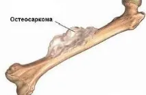 долния крайник