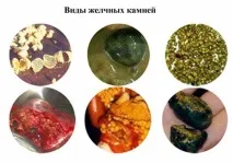 разтваряне жлъчката