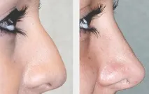 операция ринопластика