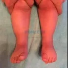 асоциация понсети