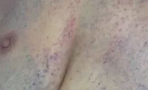 симптоми