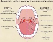 фарингит симптоми