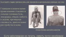 Сонна хвороба (африканський трипаносомоз) симптоми, збудник сонна