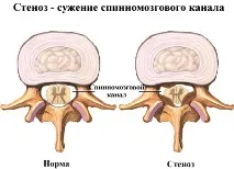 гръбначен гръбначен