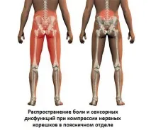 Стеноз хребетного каналу поперекового відділу поперекового
