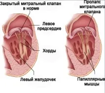 ЗБІЛЬШЕНО ЛІВОЕ ПЕРЕДСЕРДЯ, ЩО ЦЕ ЗНАЧИТЬ лівое