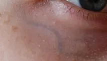 разширени вени кръвоносни съдове