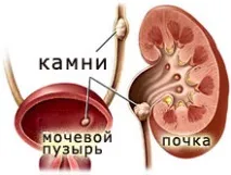Види каменів у нирках оксалатні, уратні, струвіти, фосфатні види