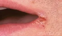 устата ухапване