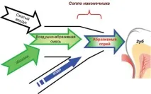 Аквакінетичний метод у терапевтичній стоматології (188) - Терапія - Новини та статті з терапія