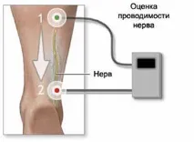 Неврит променевого нерва променевого
