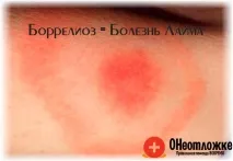 Що робити якщо вкусив кліщ перша допомога та послідовність дій Якщо