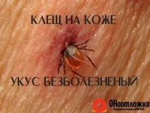 Що робити якщо вкусив кліщ перша допомога та послідовність дій вкусив