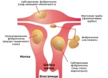 миома миома