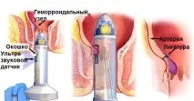 Дезартеризація гемороїдальних вузлів під ультразвуковим контролем ультразвуковим