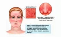 Диета розацея Диета розацея