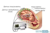 Доплерометрія увагітних, маткових артерій, показання, розшифрування, норма увагітних