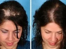 Ефективне лікування облисіння в клініці Hair For EverЖіночий порталЖіночий портал облисіння