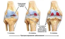 артрозі