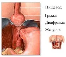 херния причинява