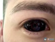 диоптри склерални