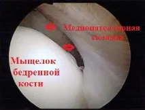 синдром медиопателарна