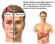 хроничен остър