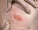 медицински борелиоза